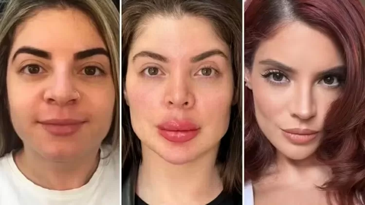 A influencer Gkay optou por remover a "harmonização facial" e passou a investir em procedimentos estéticos para estímulo de colágeno e preenchimento facial que valorizam sua beleza de forma natural.