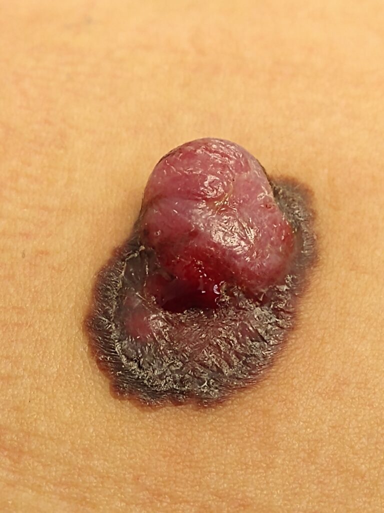 O melanoma é o câncer de pele mais agressivo, principalmente quando diagnosticado nas fases avançadas. A consulta regular com o dermatologista é a forma mais segura de preveni-lo.